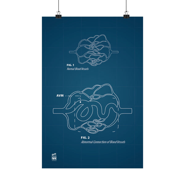 Blueprint for a Cure - AVMs | Medical Anatomy Matte Vertical Posters, Educational Artwork, Wall Decor for Science Lovers, Unique Gift for Students, Science Poster, [...]